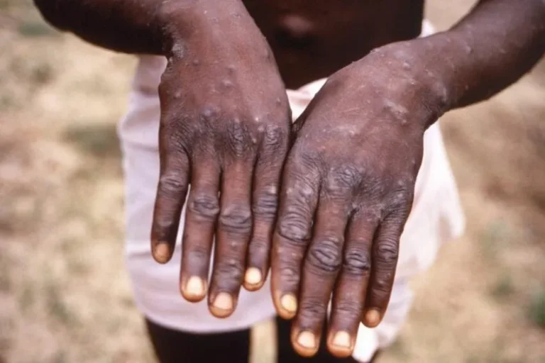 Tackling Upsurge In Mpox