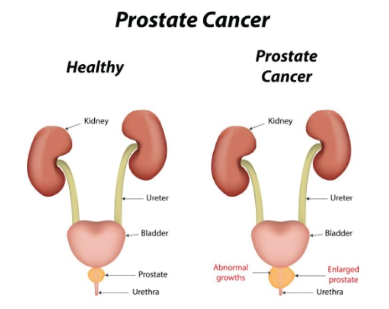 Prostate Cancer: Time For Strategic National Campaign